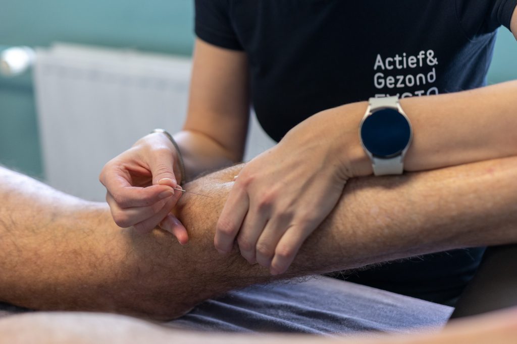 Afbeelding behandeling dry needling door fysiotherapeut in den haag